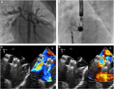 Implantation of atrial flow regulator devices in patients with congenital heart disease and children with severe pulmonary hypertension or cardiomyopathy—an international multicenter case series
